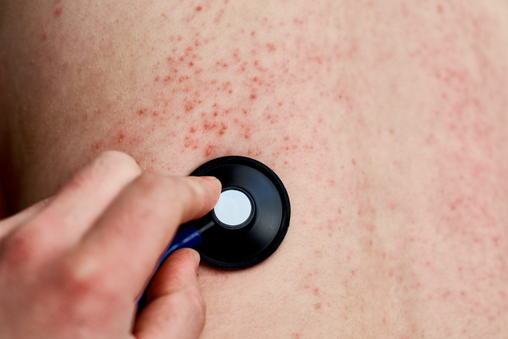 Bogotá detecta caso importado de sarampión y refuerza vigilancia sanitaria en la ciudad